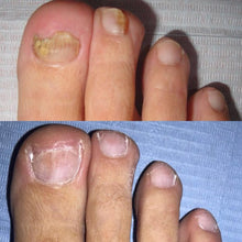 Cargar imagen en el visor de la galería, Eliminador de hongos en uñas PRONAIL FORTE™